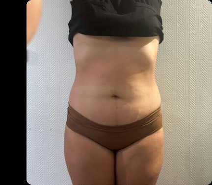 Después — Maderoterapia