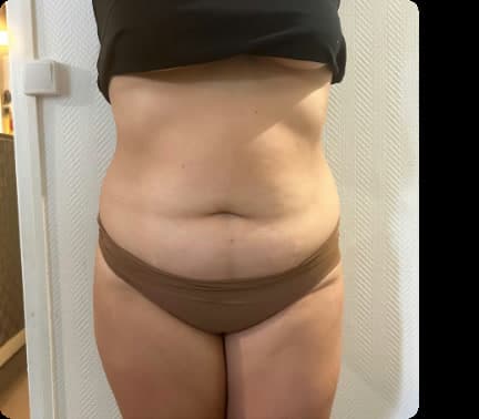 Antes — Maderoterapia