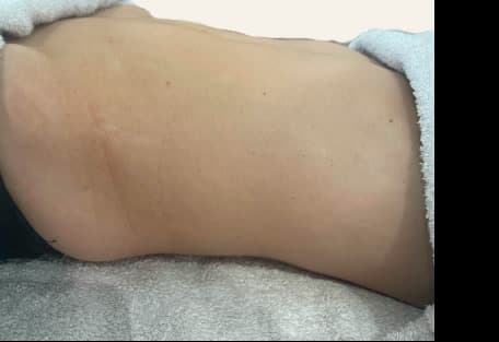 Antes — Maderoterapia